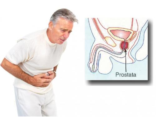 povećana prostata simptomi