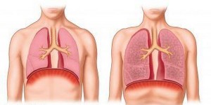 Narodni lek protiv emfizema pluća