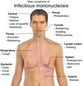 Zašto je Infektivna mononukleoza bolest poljupca